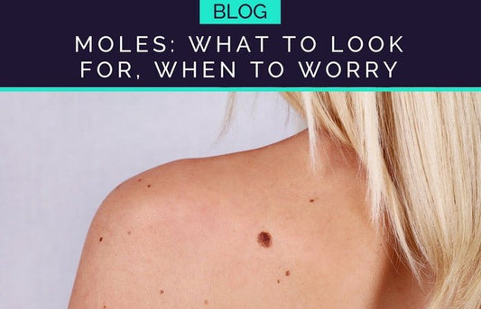 CHECKING YOUR MOLES: WHAT TO LOOK FOR - HueVine Wellness + Spa